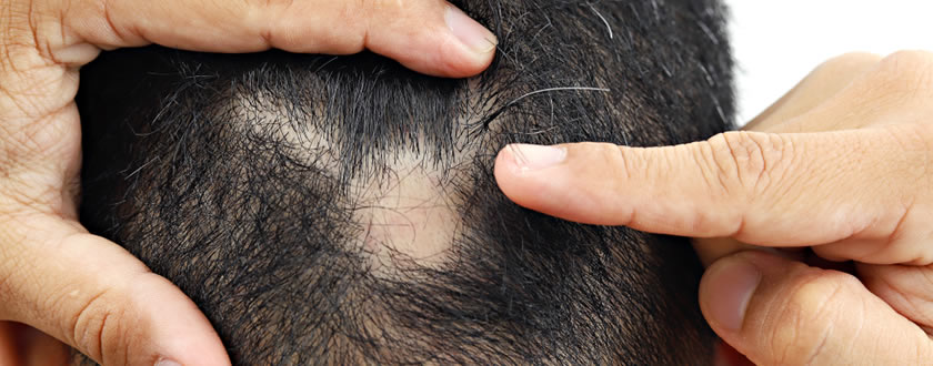 Yara, Yanık ve Ameliyat İzine Saç Ekimi