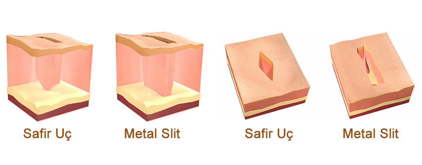 Safir Uç ile Metal Slit Arasındaki Fark
